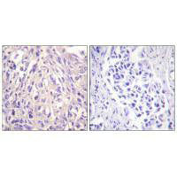Immunohistochemistry analysis of paraffin-embedded human breast carcinoma tissue using UBE1L antibody.