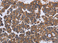 The image on the left is immunohistochemistry of paraffin-embedded Human ovarian cancer tissue using CSB-PA991151(CA4 Antibody) at dilution 1/30, on the right is treated with fusion protein. (Original magnification: ×200)