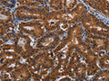 The image on the left is immunohistochemistry of paraffin-embedded Human thyroid cancer tissue using CSB-PA991655(JMJD7 Antibody) at dilution 1/20, on the right is treated with fusion protein. (Original magnification: ×200)