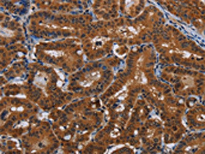 The image on the left is immunohistochemistry of paraffin-embedded Human thyroid cancer tissue using CSB-PA991655(JMJD7 Antibody) at dilution 1/20, on the right is treated with fusion protein. (Original magnification: ×200)