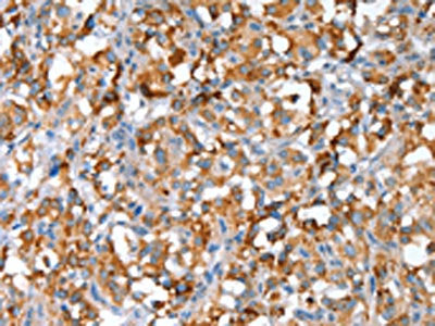 The image on the left is immunohistochemistry of paraffin-embedded Human thyroid cancer tissue using CSB-PA991705(SNAI1 Antibody) at dilution 1/30, on the right is treated with fusion protein. (Original magnification: ×200)