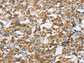 The image on the left is immunohistochemistry of paraffin-embedded Human thyroid cancer tissue using CSB-PA991727(FZD1 Antibody) at dilution 1/15, on the right is treated with synthetic peptide. (Original magnification: ×200)