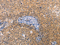 The image on the left is immunohistochemistry of paraffin-embedded Human cervical cancer tissue using CSB-PA991849(VHL Antibody) at dilution 1/40, on the right is treated with fusion protein. (Original magnification: ×200)