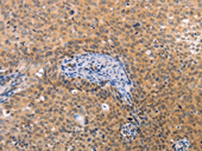The image on the left is immunohistochemistry of paraffin-embedded Human cervical cancer tissue using CSB-PA991849(VHL Antibody) at dilution 1/40, on the right is treated with fusion protein. (Original magnification: ×200)