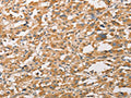 The image on the left is immunohistochemistry of paraffin-embedded Human thyroid cancer tissue using CSB-PA991992(WNT11 Antibody) at dilution 1/20, on the right is treated with fusion protein. (Original magnification: ×200)