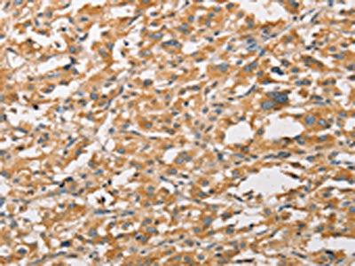The image on the left is immunohistochemistry of paraffin-embedded Human thyroid cancer tissue using CSB-PA991992(WNT11 Antibody) at dilution 1/20, on the right is treated with fusion protein. (Original magnification: ×200)