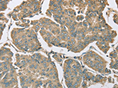 The image on the left is immunohistochemistry of paraffin-embedded Human breast cancer tissue using CSB-PA992010(EIF5 Antibody) at dilution 1/25, on the right is treated with fusion protein. (Original magnification: ×200)