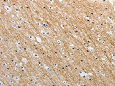 The image on the left is immunohistochemistry of paraffin-embedded Human brain tissue using CSB-PA992064(ADAMTS19 Antibody) at dilution 1/25, on the right is treated with synthetic peptide. (Original magnification: ×200)