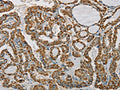 The image on the left is immunohistochemistry of paraffin-embedded Human thyroid cancer tissue using CSB-PA992496(SDHB Antibody) at dilution 1/20, on the right is treated with synthetic peptide. (Original magnification: ×200)