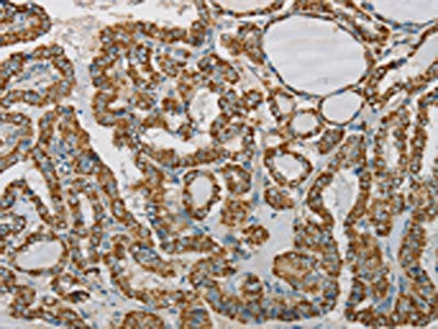 The image on the left is immunohistochemistry of paraffin-embedded Human thyroid cancer tissue using CSB-PA992496(SDHB Antibody) at dilution 1/20, on the right is treated with synthetic peptide. (Original magnification: ×200)