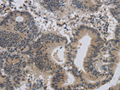 The image on the left is immunohistochemistry of paraffin-embedded Human colon cancer tissue using CSB-PA992612(ALX4 Antibody) at dilution 1/20, on the right is treated with synthetic peptide. (Original magnification: ×200)