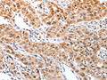 The image on the left is immunohistochemistry of paraffin-embedded Human lung cancer tissue using CSB-PA992708(DPPA2 Antibody) at dilution 1/30, on the right is treated with fusion protein. (Original magnification: ×200)