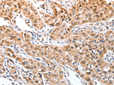 The image on the left is immunohistochemistry of paraffin-embedded Human lung cancer tissue using CSB-PA992708(DPPA2 Antibody) at dilution 1/30, on the right is treated with fusion protein. (Original magnification: ×200)