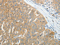 The image on the left is immunohistochemistry of paraffin-embedded Human ovarian cancer tissue using CSB-PA993202(PRDX5 Antibody) at dilution 1/25, on the right is treated with fusion protein. (Original magnification: ×200)