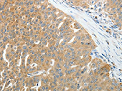 The image on the left is immunohistochemistry of paraffin-embedded Human ovarian cancer tissue using CSB-PA993202(PRDX5 Antibody) at dilution 1/25, on the right is treated with fusion protein. (Original magnification: ×200)