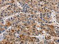 The image on the left is immunohistochemistry of paraffin-embedded Human liver cancer tissue using CSB-PA993284(PIM1 Antibody) at dilution 1/40, on the right is treated with fusion protein. (Original magnification: ×200)