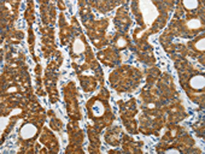 The image on the left is immunohistochemistry of paraffin-embedded Human thyroid cancer tissue using CSB-PA993400(PRDX5 Antibody) at dilution 1/40, on the right is treated with fusion protein. (Original magnification: ×200)