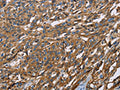 The image on the left is immunohistochemistry of paraffin-embedded Human esophagus cancer tissue using CSB-PA993569(BSG Antibody) at dilution 1/60, on the right is treated with fusion protein. (Original magnification: ×200)