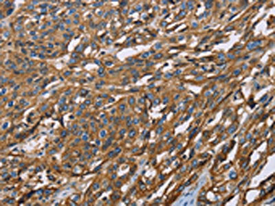 The image on the left is immunohistochemistry of paraffin-embedded Human esophagus cancer tissue using CSB-PA993569(BSG Antibody) at dilution 1/60, on the right is treated with fusion protein. (Original magnification: ×200)