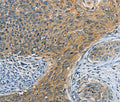 Immunohistochemical analysis of paraffin-embedded Human cervical cancer tissue using at dilution 1/20.