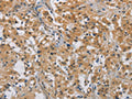 The image on the left is immunohistochemistry of paraffin-embedded Human thyroid cancer tissue using CSB-PA994119(DDX43 Antibody) at dilution 1/50, on the right is treated with fusion protein. (Original magnification: ×200)