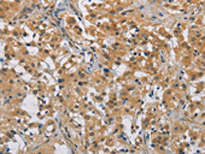 The image on the left is immunohistochemistry of paraffin-embedded Human thyroid cancer tissue using CSB-PA994119(DDX43 Antibody) at dilution 1/50, on the right is treated with fusion protein. (Original magnification: ×200)