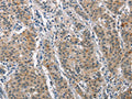 The image on the left is immunohistochemistry of paraffin-embedded Human gastic cancer tissue using CSB-PA994185(MAPT Antibody) at dilution 1/25, on the right is treated with synthetic peptide. (Original magnification: ×200)