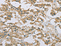 The image on the left is immunohistochemistry of paraffin-embedded Human thyroid cancer tissue using CSB-PA994433(EEF2 Antibody) at dilution 1/20, on the right is treated with fusion protein. (Original magnification: ×200)