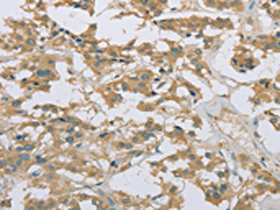 The image on the left is immunohistochemistry of paraffin-embedded Human thyroid cancer tissue using CSB-PA994433(EEF2 Antibody) at dilution 1/20, on the right is treated with fusion protein. (Original magnification: ×200)