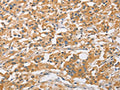 The image on the left is immunohistochemistry of paraffin-embedded Human thyroid cancer tissue using CSB-PA994626(ARL8A Antibody) at dilution 1/20, on the right is treated with fusion protein. (Original magnification: ×200)