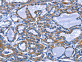 The image on the left is immunohistochemistry of paraffin-embedded Human thyroid cancer tissue using CSB-PA994634(IFNG Antibody) at dilution 1/25, on the right is treated with fusion protein. (Original magnification: ×200)