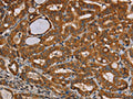 The image on the left is immunohistochemistry of paraffin-embedded Human thyroid cancer tissue using CSB-PA994661(CENPU Antibody) at dilution 1/30, on the right is treated with fusion protein. (Original magnification: ×200)
