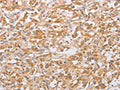 The image on the left is immunohistochemistry of paraffin-embedded Human thyroid cancer tissue using CSB-PA994683(CSGALNACT2 Antibody) at dilution 1/30, on the right is treated with fusion protein. (Original magnification: ×200)