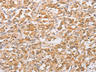 The image on the left is immunohistochemistry of paraffin-embedded Human thyroid cancer tissue using CSB-PA994683(CSGALNACT2 Antibody) at dilution 1/30, on the right is treated with fusion protein. (Original magnification: ×200)