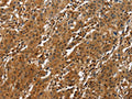 The image on the left is immunohistochemistry of paraffin-embedded Human gastic cancer tissue using CSB-PA994815(ATF4 Antibody) at dilution 1/50, on the right is treated with fusion protein. (Original magnification: ×200)
