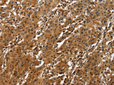 The image on the left is immunohistochemistry of paraffin-embedded Human gastic cancer tissue using CSB-PA994815(ATF4 Antibody) at dilution 1/50, on the right is treated with fusion protein. (Original magnification: ×200)