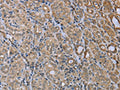 The image on the left is immunohistochemistry of paraffin-embedded Human thyroid cancer tissue using CSB-PA994832(MAPRE3 Antibody) at dilution 1/20, on the right is treated with fusion protein. (Original magnification: ×200)