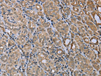 The image on the left is immunohistochemistry of paraffin-embedded Human thyroid cancer tissue using CSB-PA994832(MAPRE3 Antibody) at dilution 1/20, on the right is treated with fusion protein. (Original magnification: ×200)