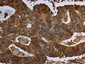 The image on the left is immunohistochemistry of paraffin-embedded Human colon cancer tissue using CSB-PA994843(HPGD Antibody) at dilution 1/30, on the right is treated with fusion protein. (Original magnification: ×200)