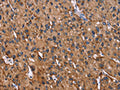 The image on the left is immunohistochemistry of paraffin-embedded Human liver cancer tissue using CSB-PA995283(LAMP2 Antibody) at dilution 1/30, on the right is treated with fusion protein. (Original magnification: ×200)