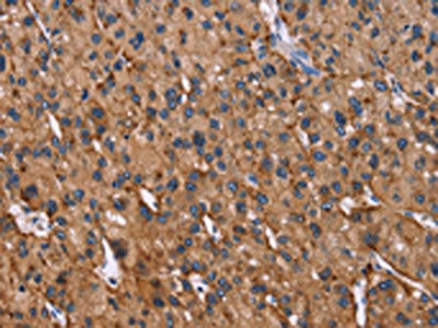 The image on the left is immunohistochemistry of paraffin-embedded Human liver cancer tissue using CSB-PA995283(LAMP2 Antibody) at dilution 1/30, on the right is treated with fusion protein. (Original magnification: ×200)
