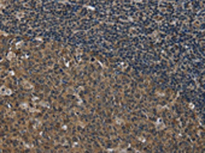 The image on the left is immunohistochemistry of paraffin-embedded Human tonsil tissue using CSB-PA995563(SETD7 Antibody) at dilution 1/20, on the right is treated with fusion protein. (Original magnification: ×200)