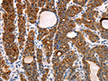 The image on the left is immunohistochemistry of paraffin-embedded Human thyroid cancer tissue using CSB-PA995687(RAMP1 Antibody) at dilution 1/10, on the right is treated with fusion protein. (Original magnification: ×200)