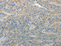 The image on the left is immunohistochemistry of paraffin-embedded Human ovarian cancer tissue using CSB-PA995819(SPATA17 Antibody) at dilution 1/15, on the right is treated with fusion protein. (Original magnification: ×200)