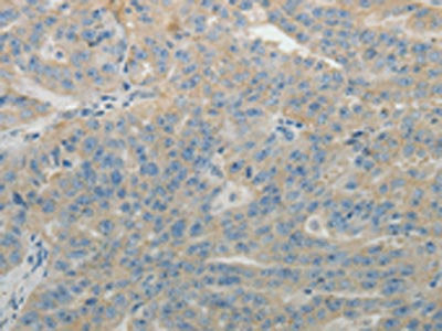 The image on the left is immunohistochemistry of paraffin-embedded Human ovarian cancer tissue using CSB-PA995819(SPATA17 Antibody) at dilution 1/15, on the right is treated with fusion protein. (Original magnification: ×200)