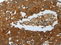 The image on the left is immunohistochemistry of paraffin-embedded Human breast cancer tissue using CSB-PA995911(MYD88 Antibody) at dilution 1/20, on the right is treated with fusion protein. (Original magnification: ×200)
