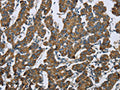 The image on the left is immunohistochemistry of paraffin-embedded Human breast cancer tissue using CSB-PA995962(KRT5 Antibody) at dilution 1/25, on the right is treated with fusion protein. (Original magnification: ×200)