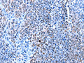 The image on the left is immunohistochemistry of paraffin-embedded Human ovarian cancer tissue using CSB-PA995991(HMGB1 Antibody) at dilution 1/13, on the right is treated with synthetic peptide. (Original magnification: ×200)
