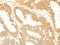 The image on the left is immunohistochemistry of paraffin-embedded Human colon cancer tissue using CSB-PA996161(TERF1 Antibody) at dilution 1/20, on the right is treated with fusion protein. (Original magnification: ×200)