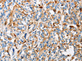 The image on the left is immunohistochemistry of paraffin-embedded Human esophagus cancer tissue using CSB-PA996311(CTSL Antibody) at dilution 1/50, on the right is treated with fusion protein. (Original magnification: ×200)